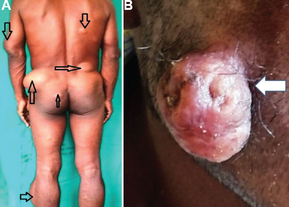 (A) Patient with multiple swellings over the body. (B) Pedunculated swelling over the right cheek.